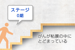ステージ0期の治療方針