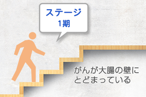 ステージ1期の治療方針