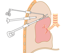 腹腔鏡検査