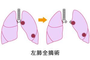 肺全摘術