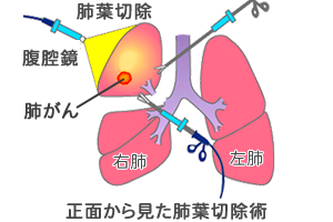 腹腔鏡手術