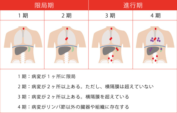 悪性 リンパ腫 再発 率