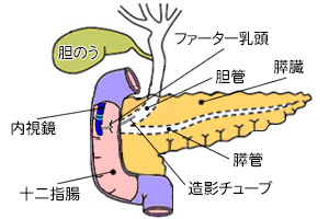 ERCP検査(内視鏡的逆行性胆管膵管造影)