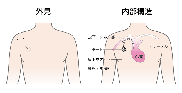 癌治療に用いられるcvポートについて がん治療ならnpo法人日本統合医療推奨協会