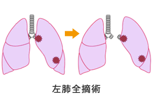 片側肺全摘手術