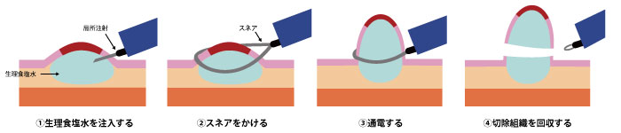 内視鏡的粘膜切除術（EMR)