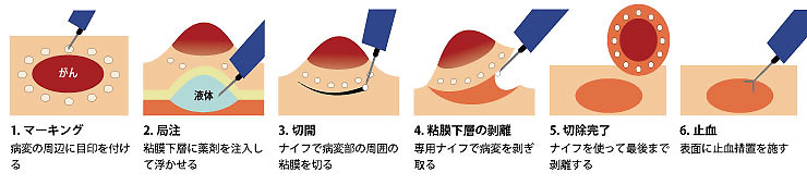 内視鏡的粘膜下層剥離術（ＥＳＤ）