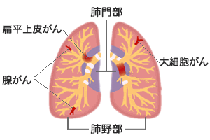 非小細胞肺がん