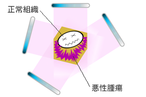 放射線療法の副作用