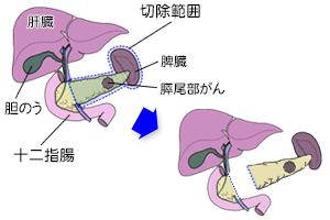 膵体尾部切除術