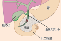 ステント留置手術