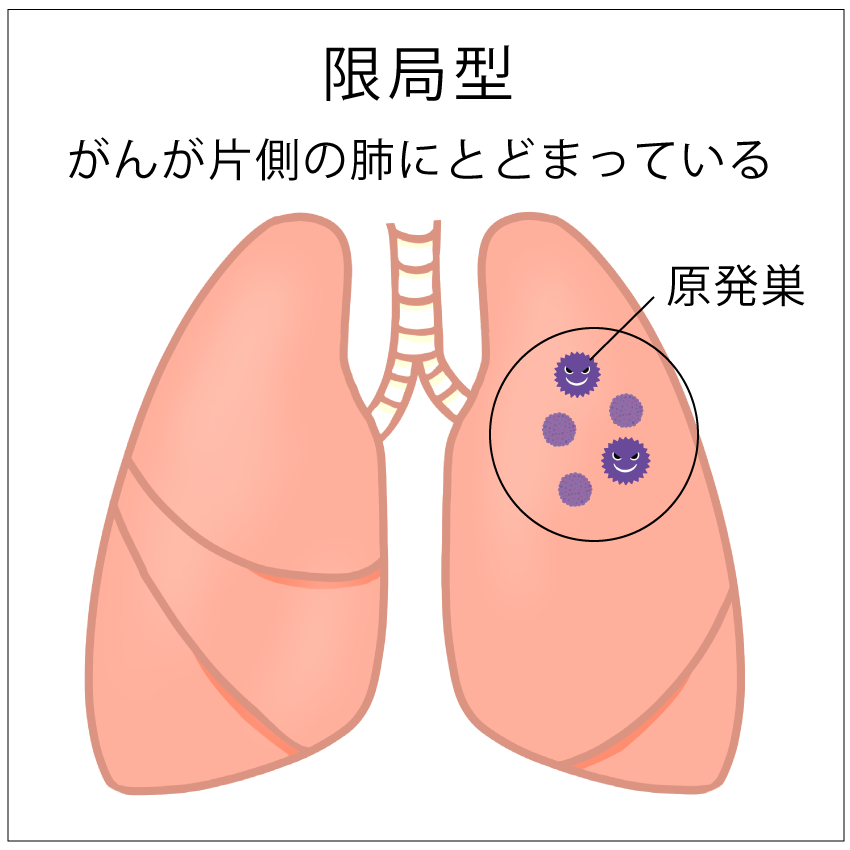 限局型肺がんの図