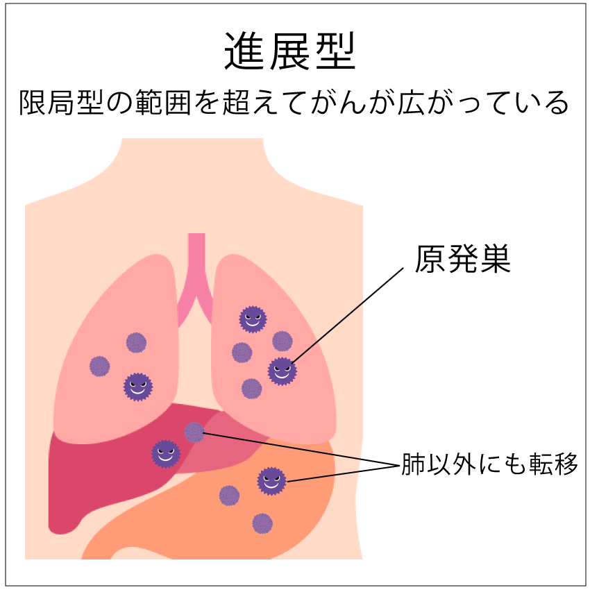 小細胞肺がんの進展型